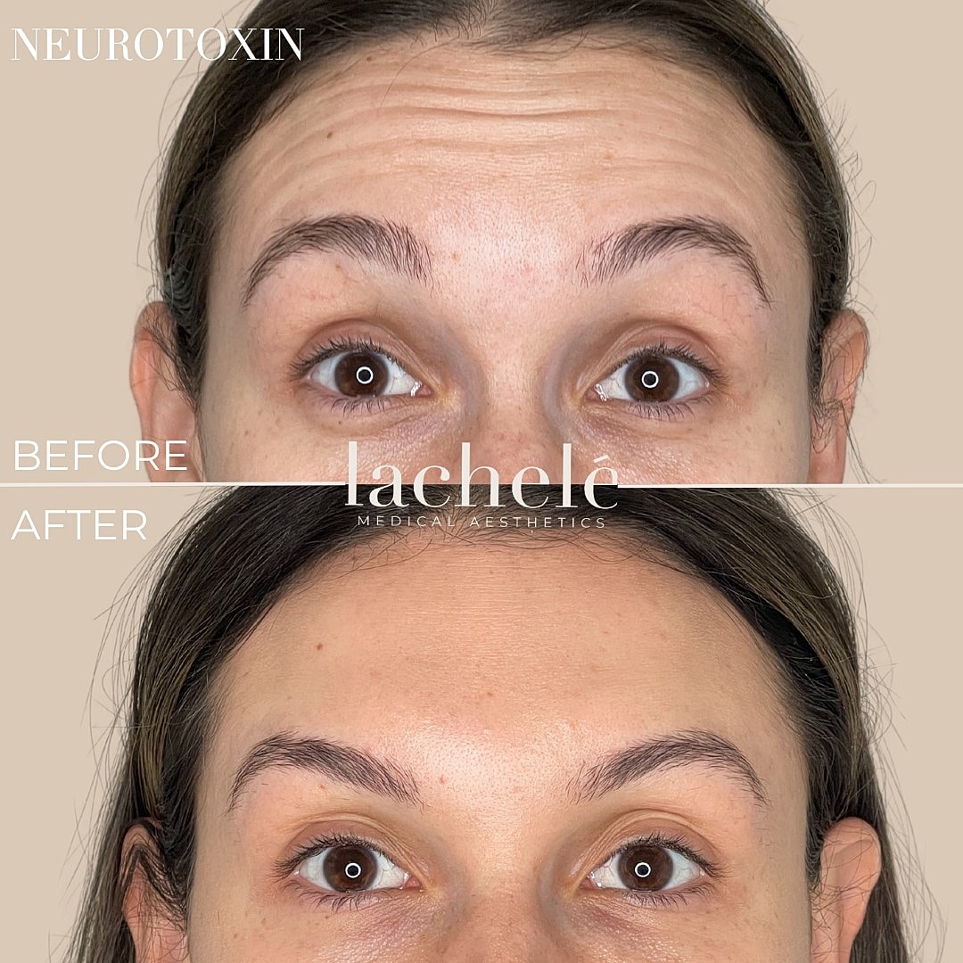 Before and after neurotoxin treatment results