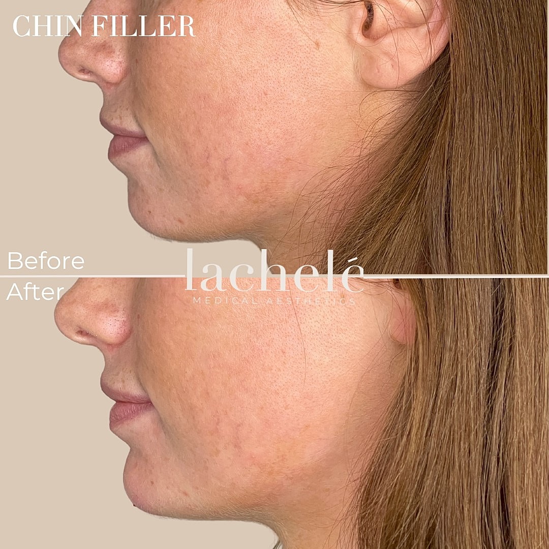 Chin filler before and after transformation.