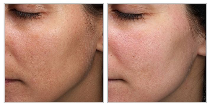 Before and after of Sciton Moxi Prejuvenation Laser