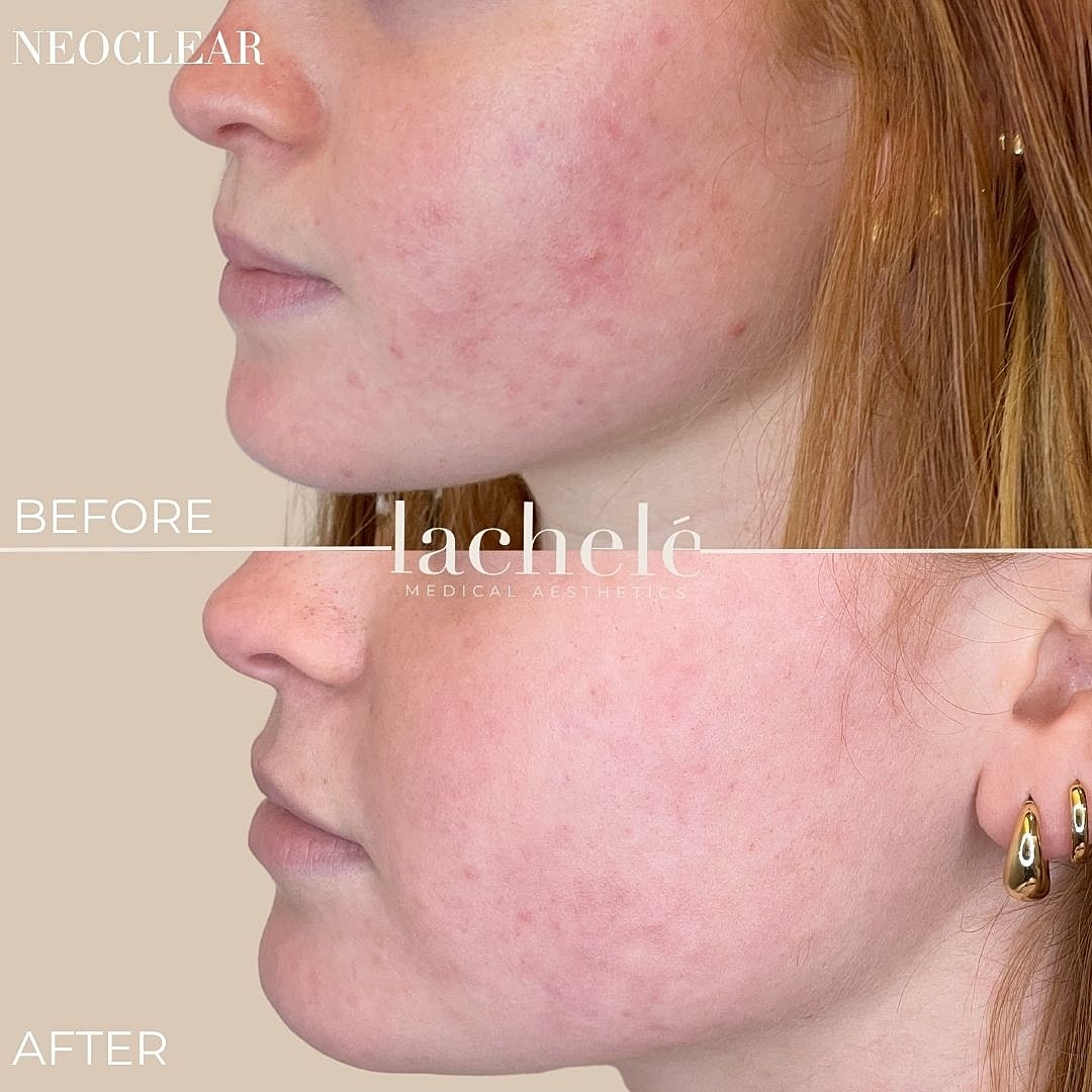 Before and after skin treatment comparison.