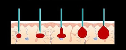 Blood droplet formation process illustration.