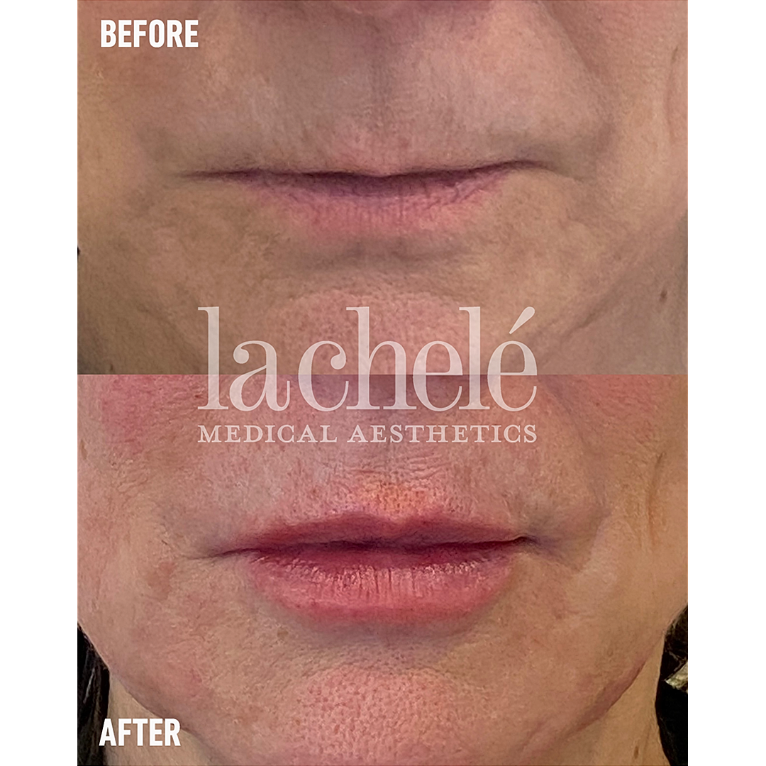 lip filler before and after