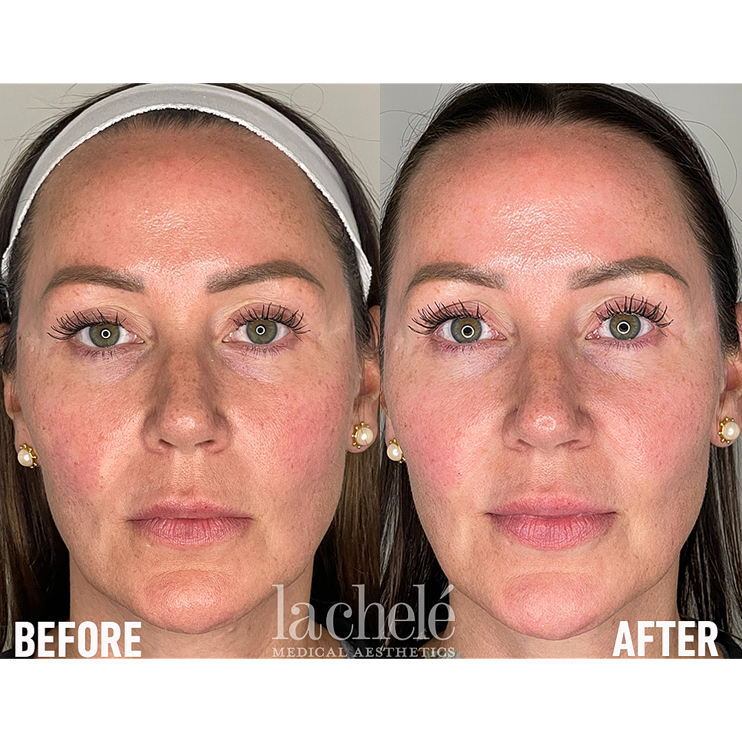 Before and after facial aesthetics treatment comparison.
