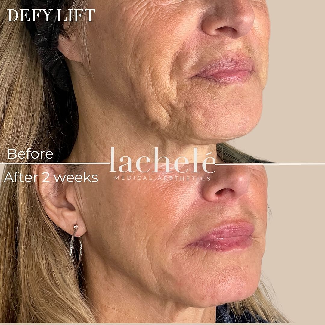 Before and after facial treatment transformation.