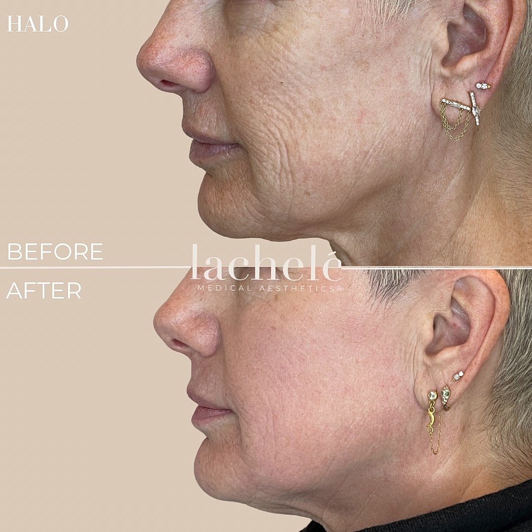 Before and after skin treatment comparison side profile