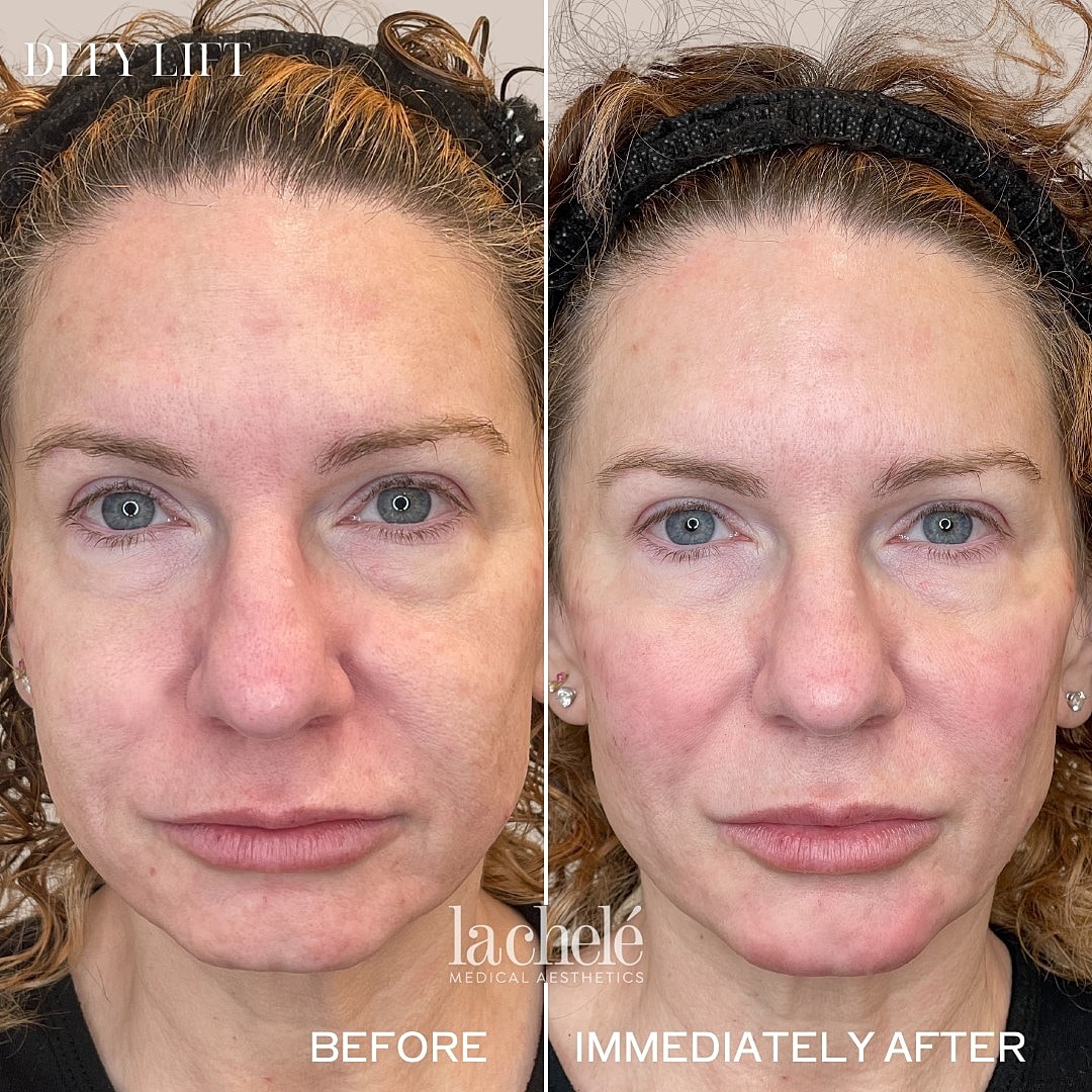 Before and after facial treatment results.