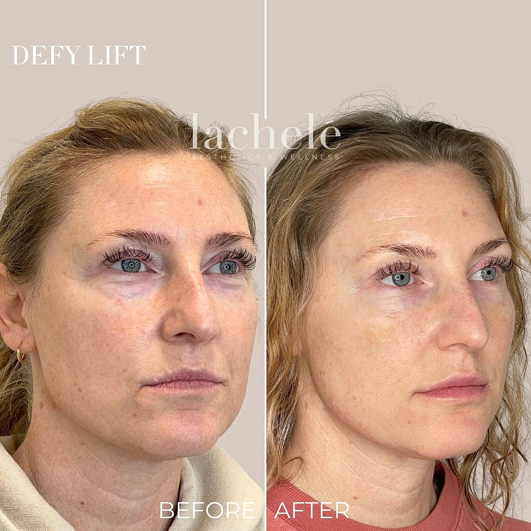 Before and after defy lift treatment comparison.