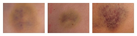 Different stages of bruising on skin.