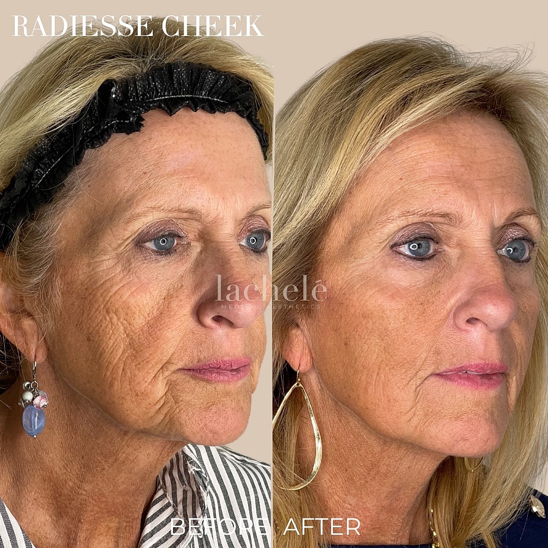 Radiesse cheek treatment before and after results