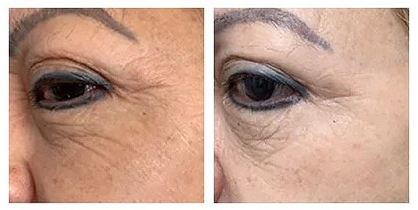 Before and after eye rejuvenation treatment comparison.