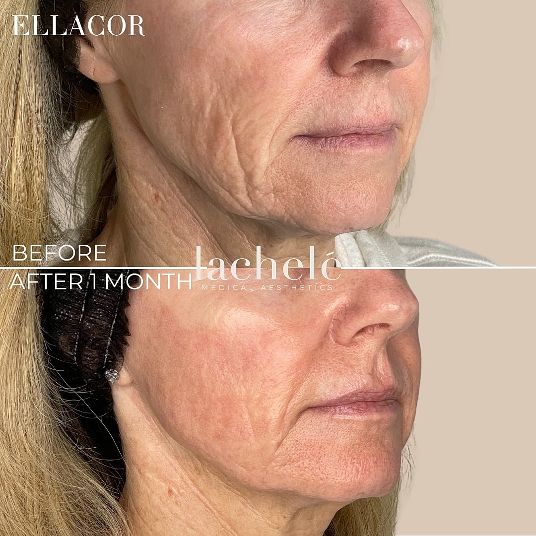 Skin treatment results after one month comparison.