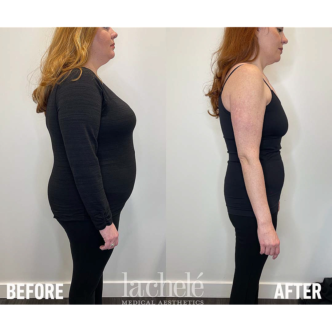 Ozempic for weight loss before and after