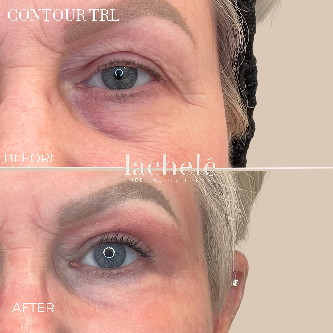 Before and after contour treatment comparison.