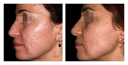 Before and after facial treatment comparison.