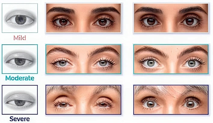 Comparison of mild, moderate, and severe eye conditions.