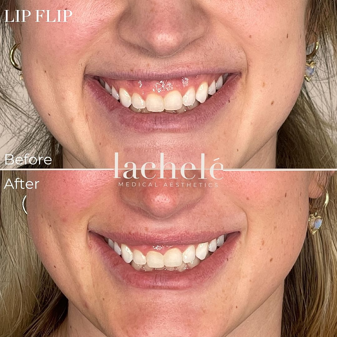 Lip flip before and after transformation comparison