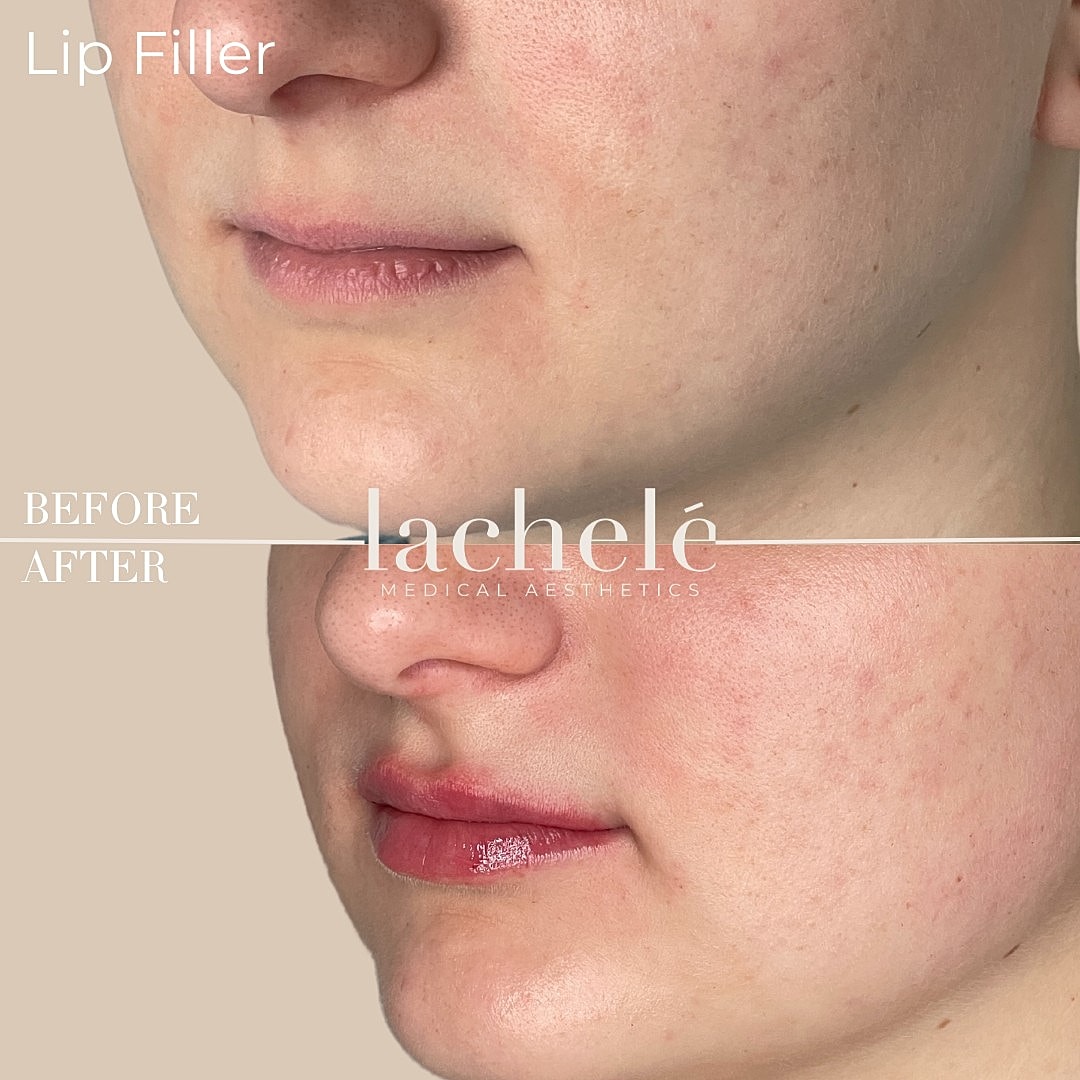 Lip filler before and after transformation image.