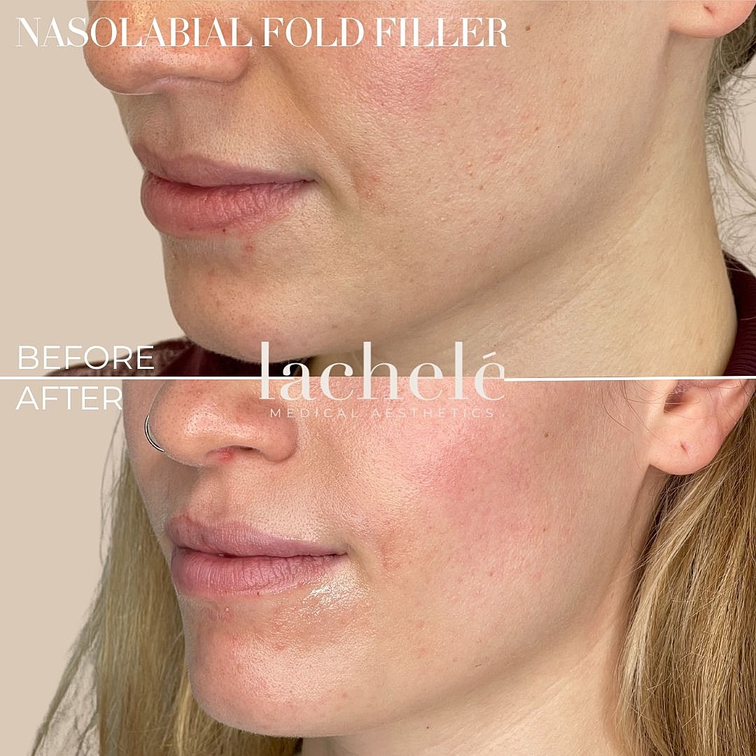 Nasolabial fold filler before and after results.