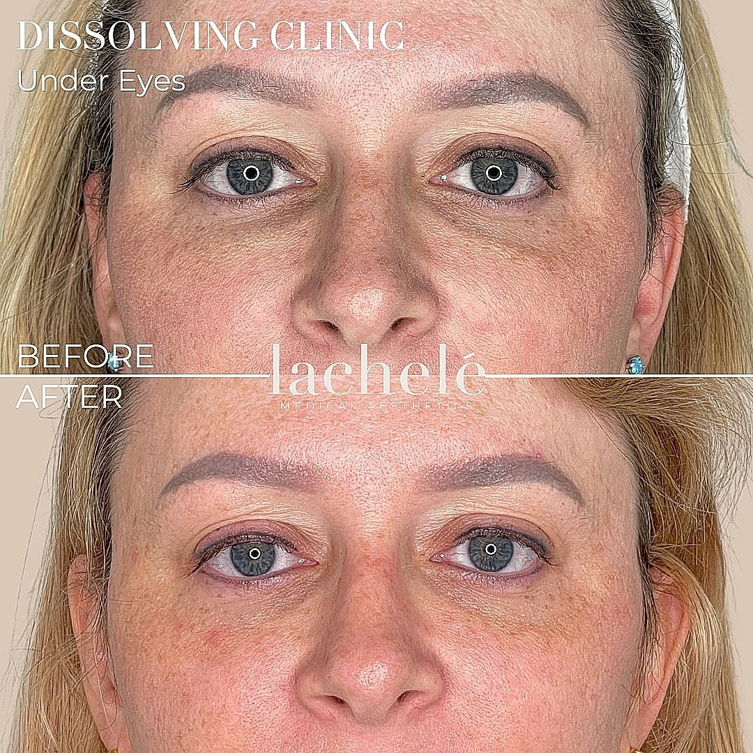 Before and after under-eye treatment comparison.