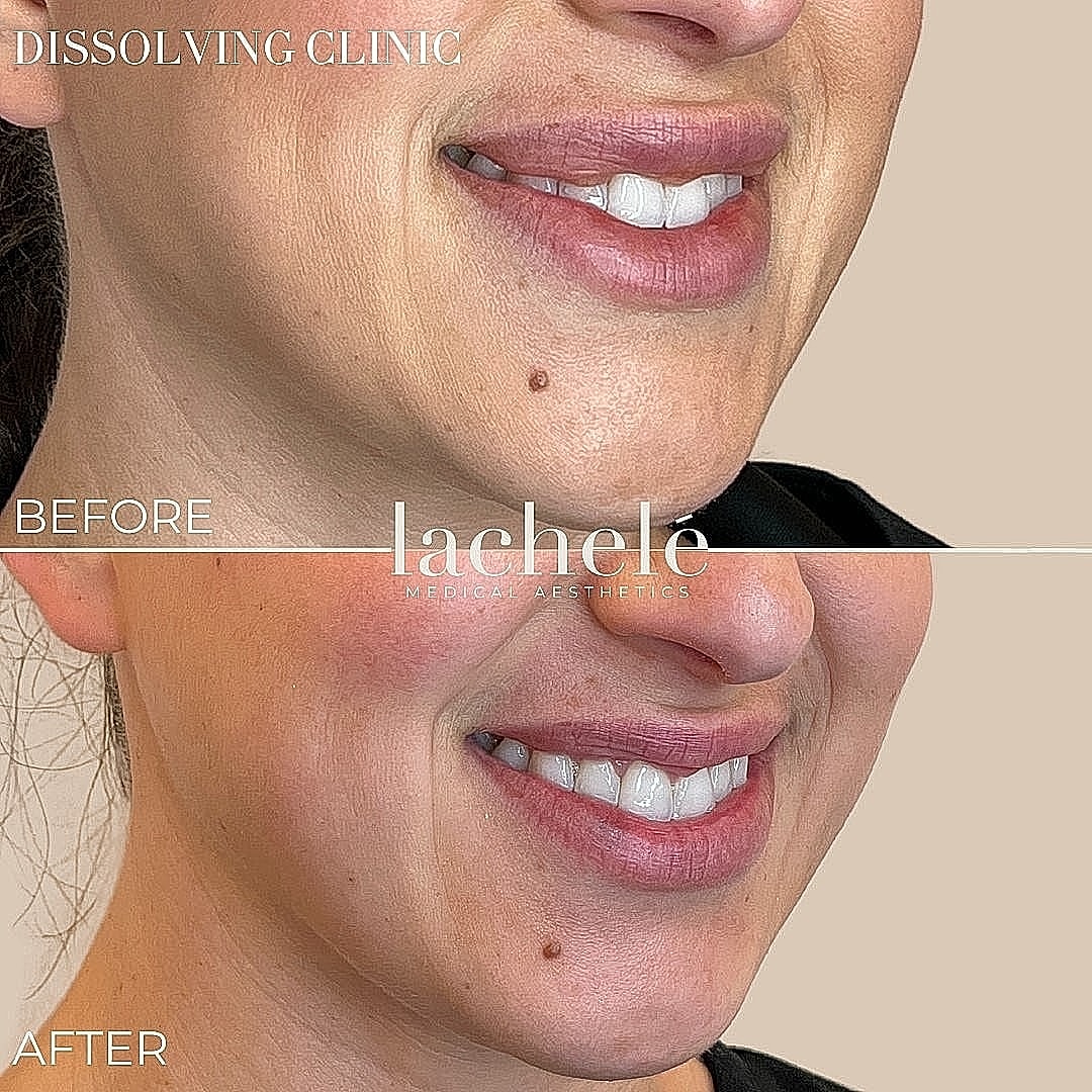 Before and after aesthetic treatment smile comparison.