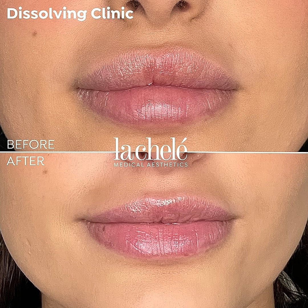 Before and after lip treatment comparison.