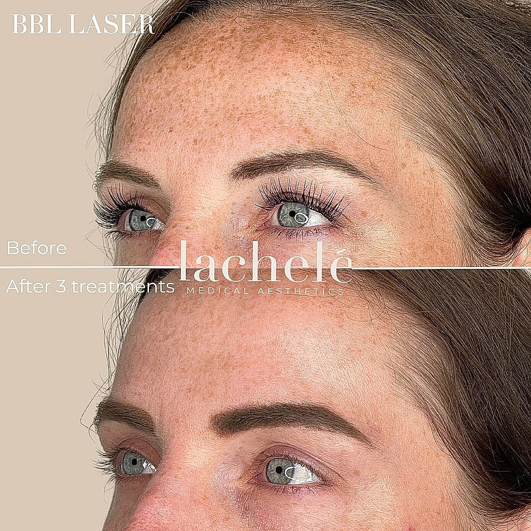 BBL laser treatment before and after comparison.