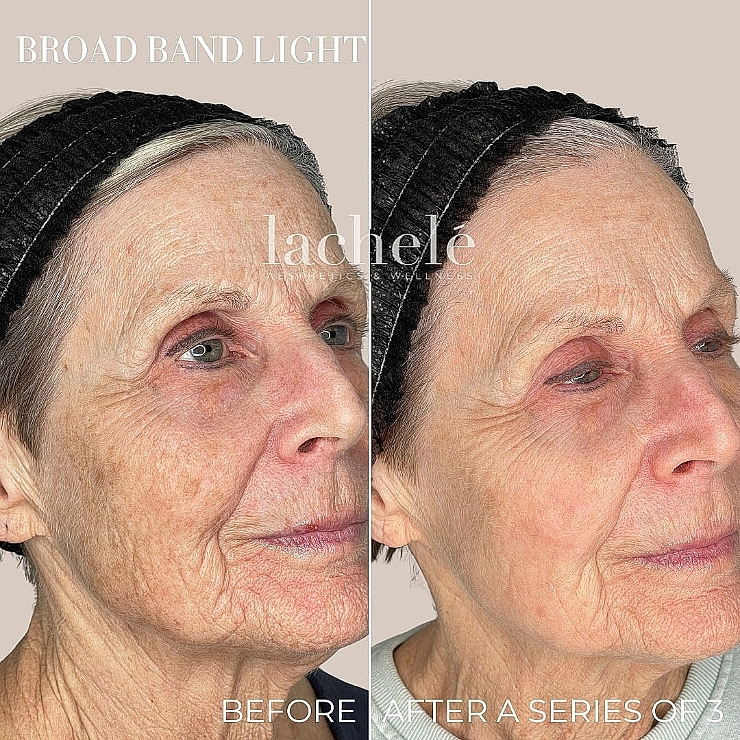 Broad band light treatment before and after comparison.