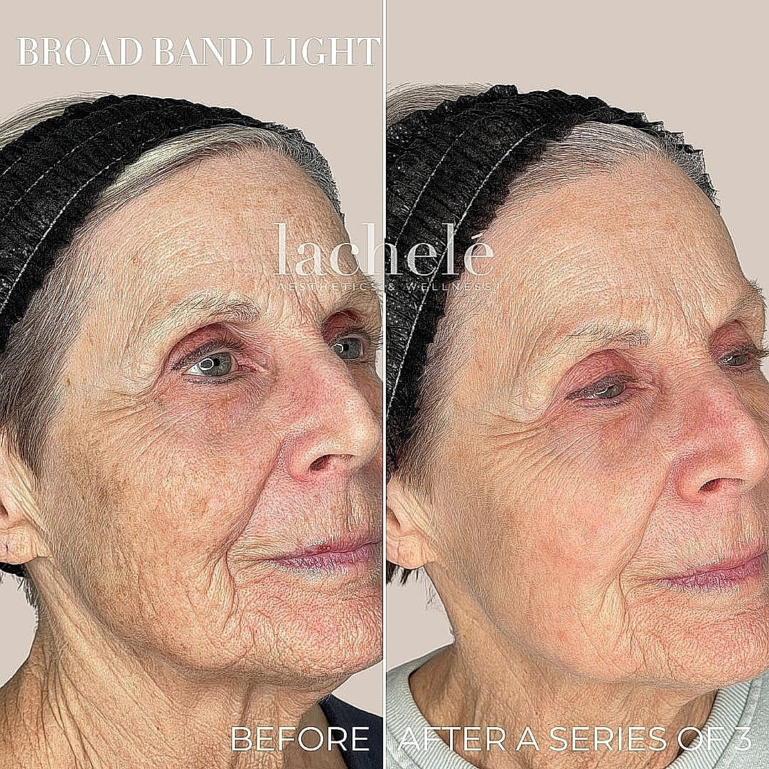 Before and after broad band light treatment.