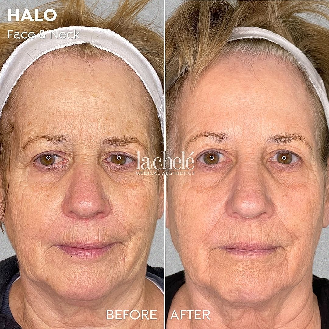 Before and after HALO face and neck treatment.