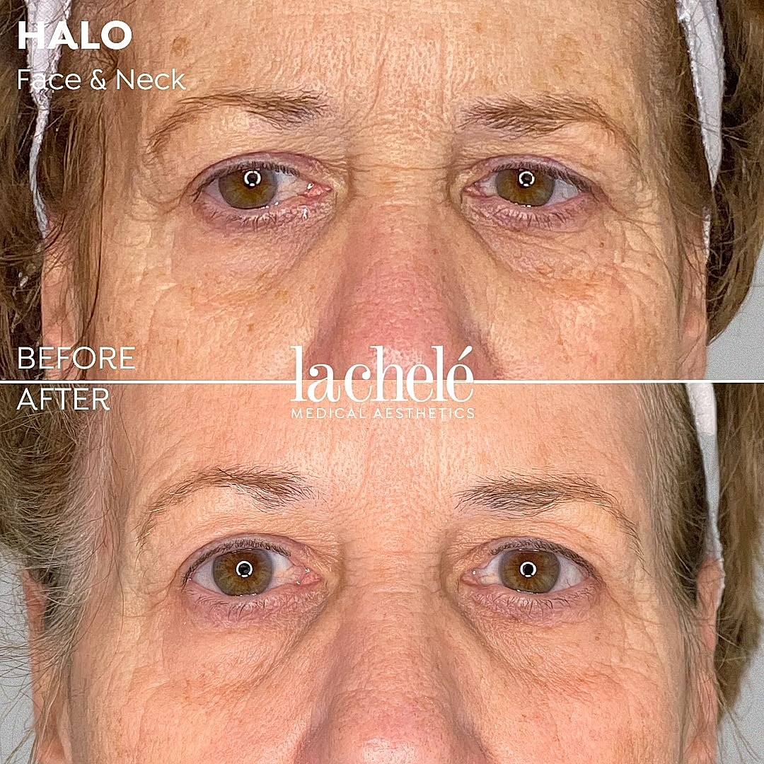 Before and after facial rejuvenation treatment.