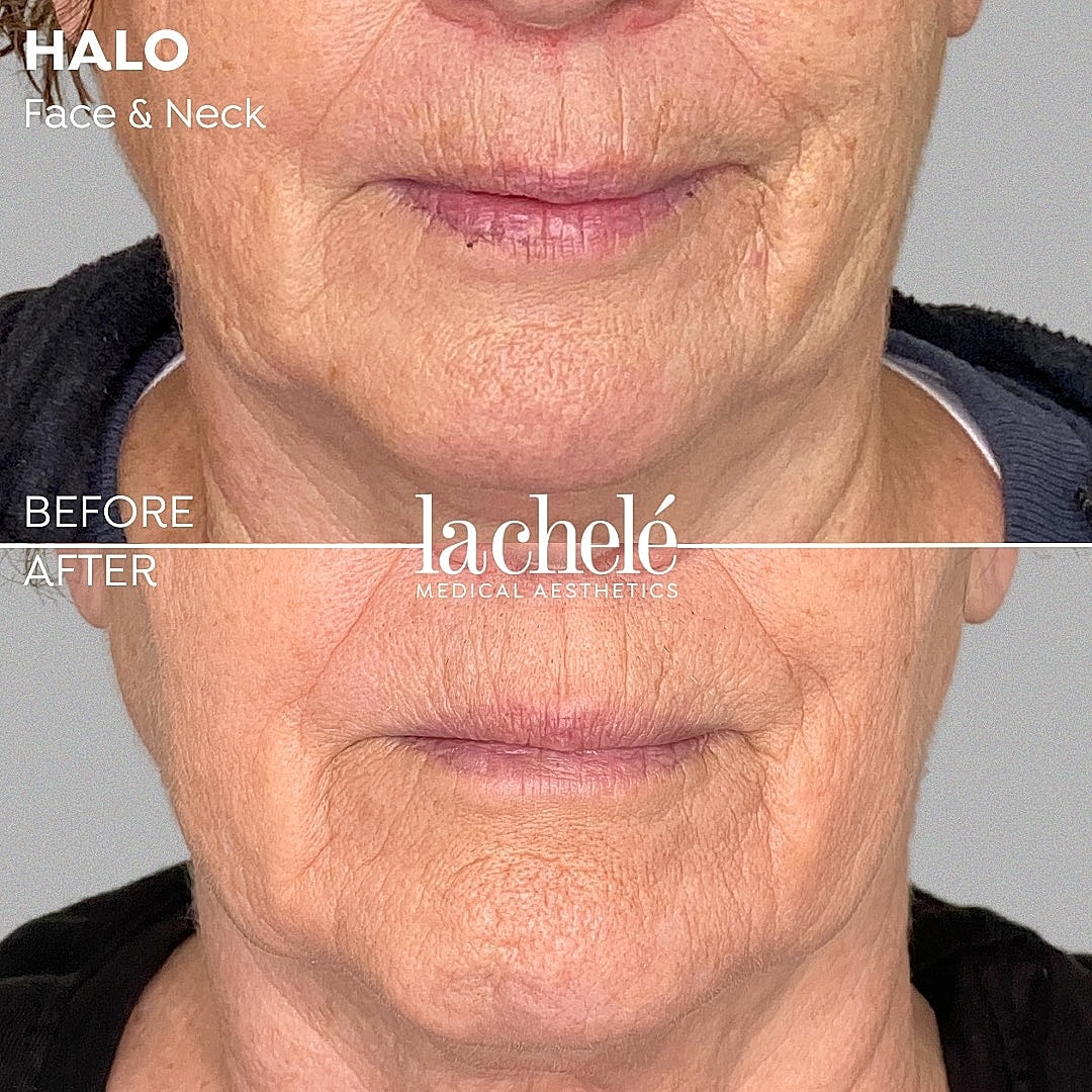 Before and after facial rejuvenation treatment results.