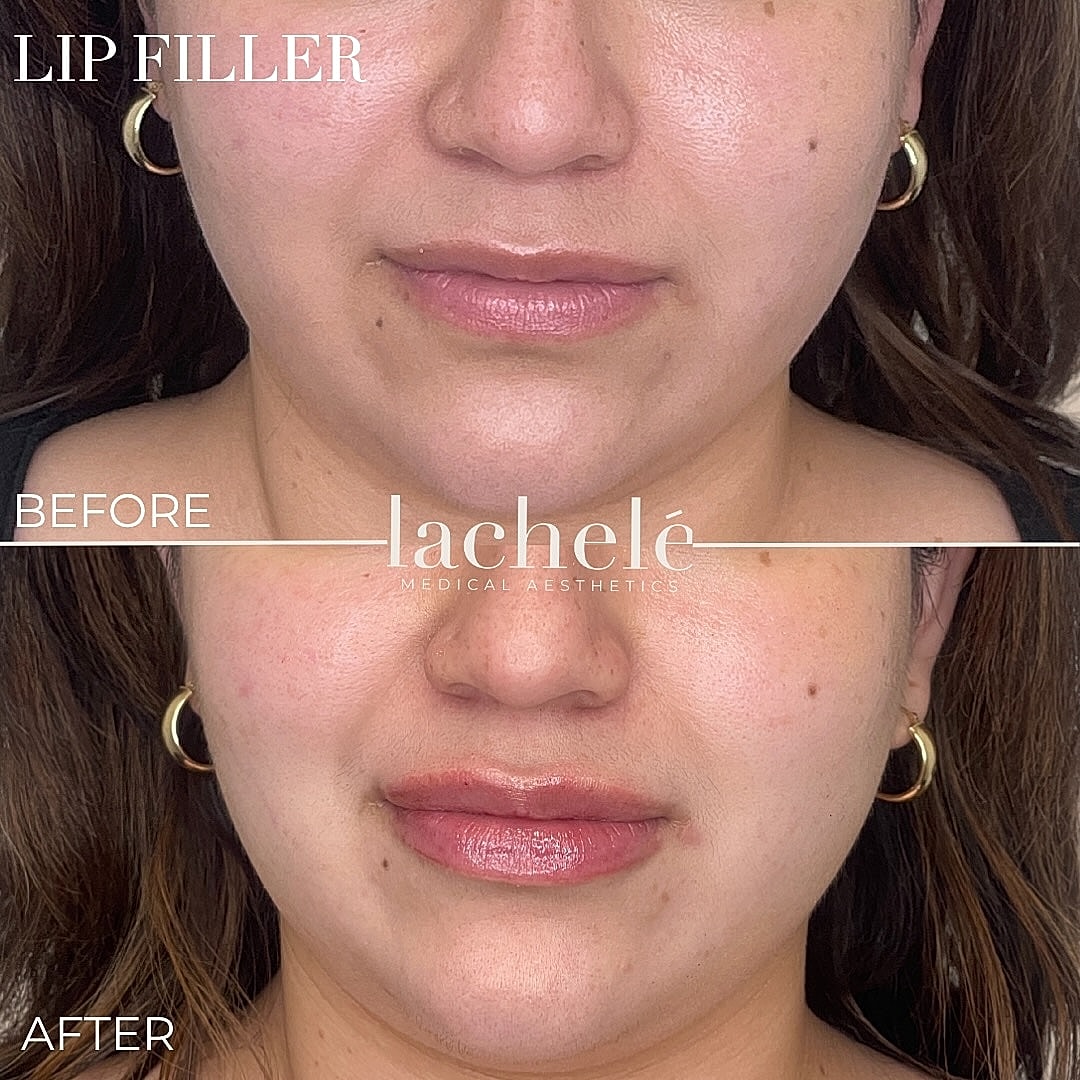 Before and after lip filler treatment comparison.