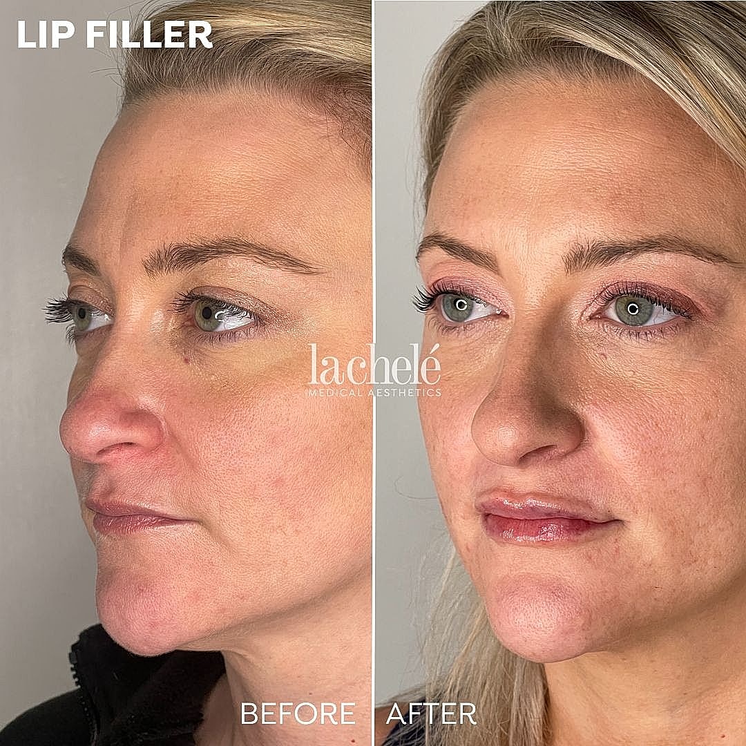 Before and after lip filler treatment comparison.