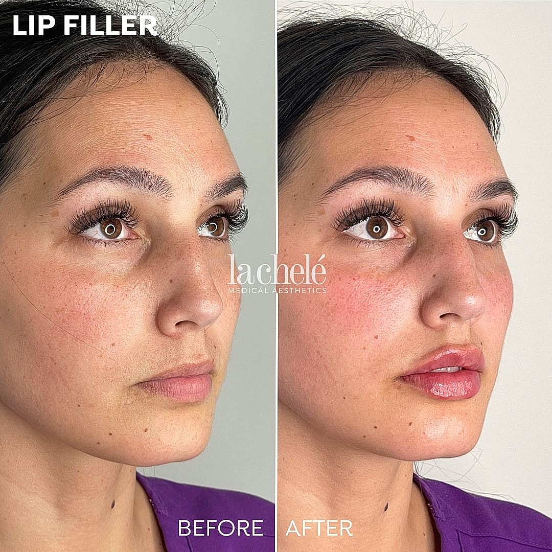 Lip filler before and after transformation image.