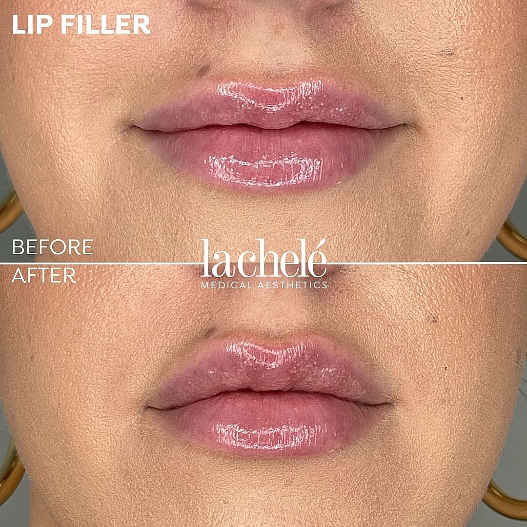 Before and after lip filler treatment效果
