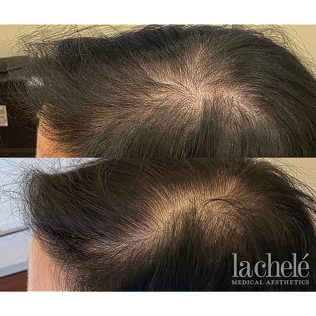 Before and after hair restoration treatment results.