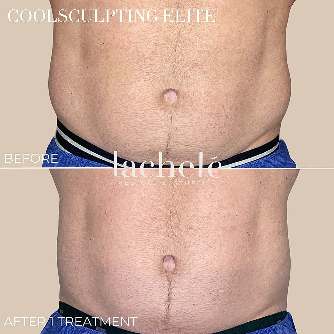 CoolSculpting treatment before and after results