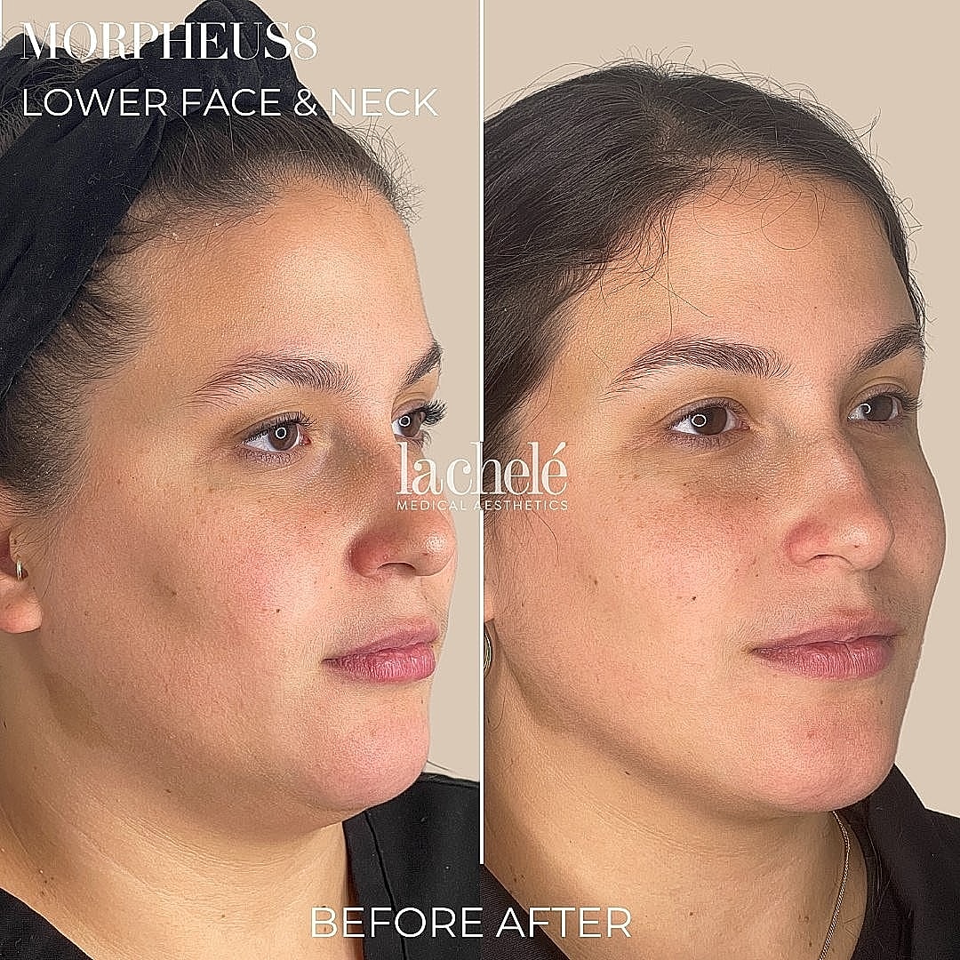 Before and after Morpheus8 treatment results.