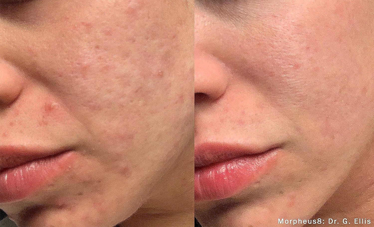 Before and after skin treatment comparison.