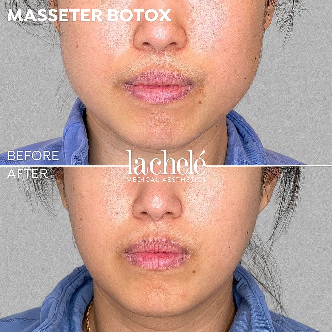 Masseter Botox before and after treatment comparison.