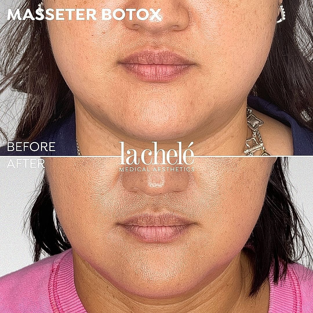 Masseter Botox before and after comparison image