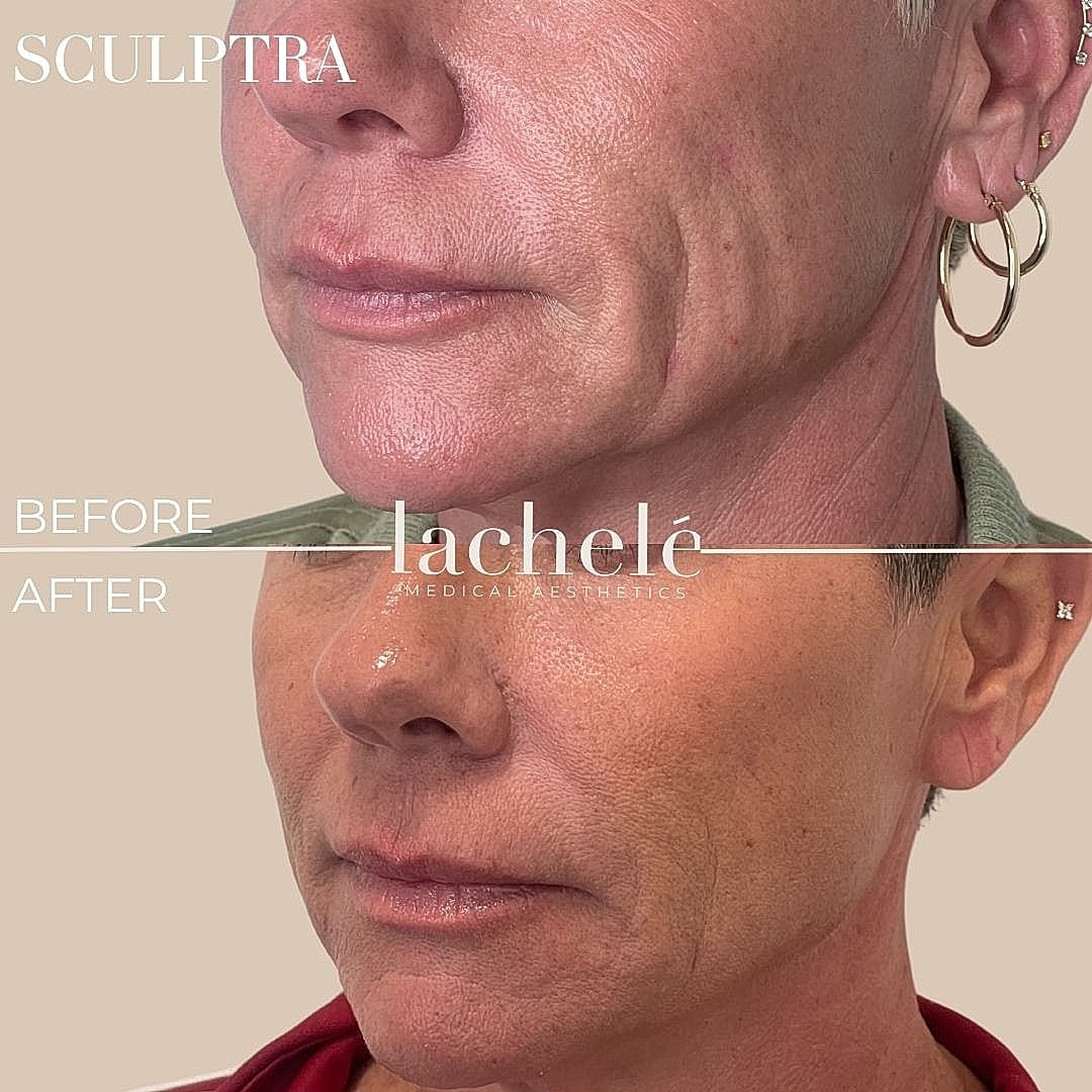 Sculptra before and after facial treatment.