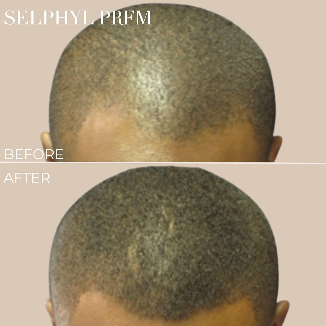 Hair restoration results before and after treatment