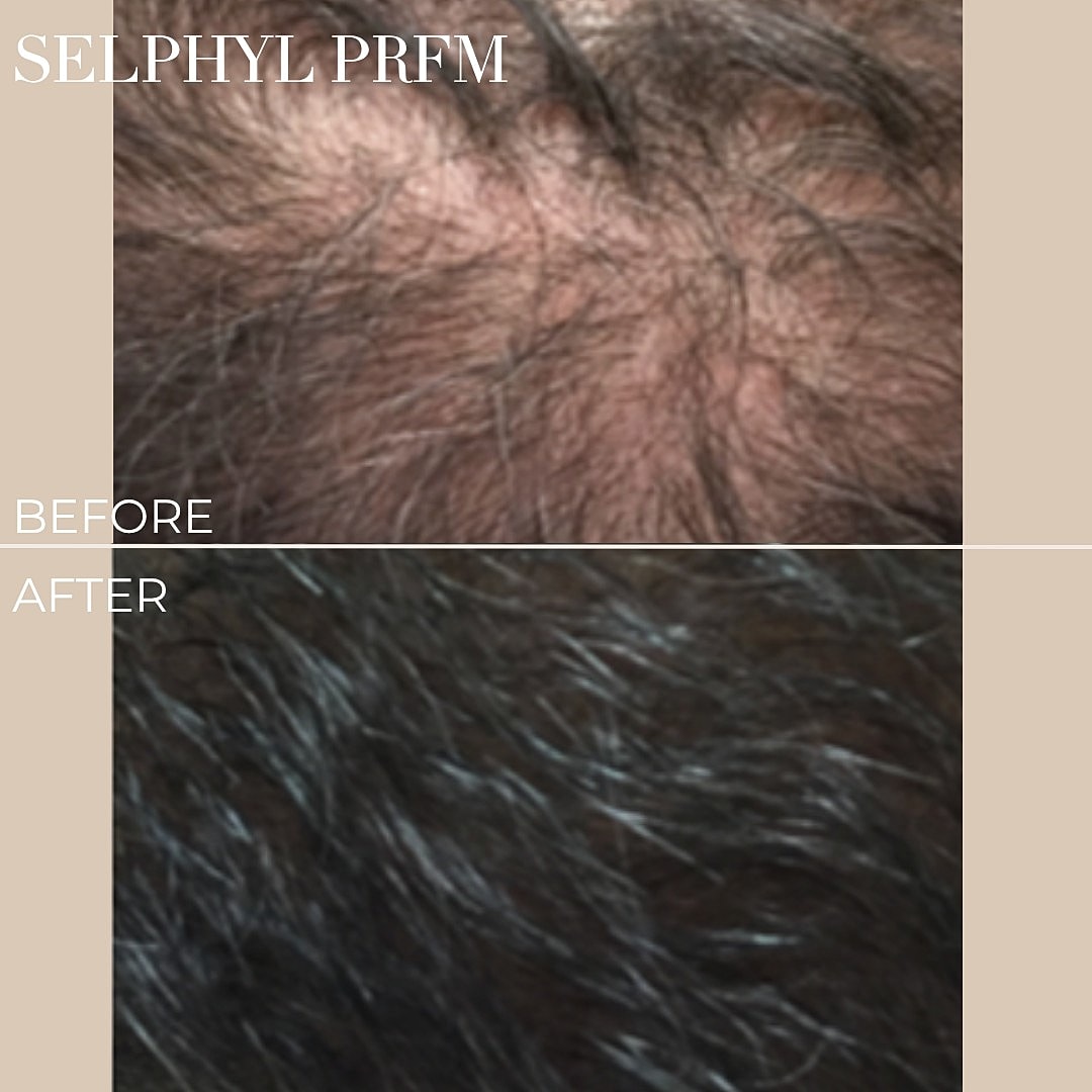 Before and after hair restoration treatment comparison.