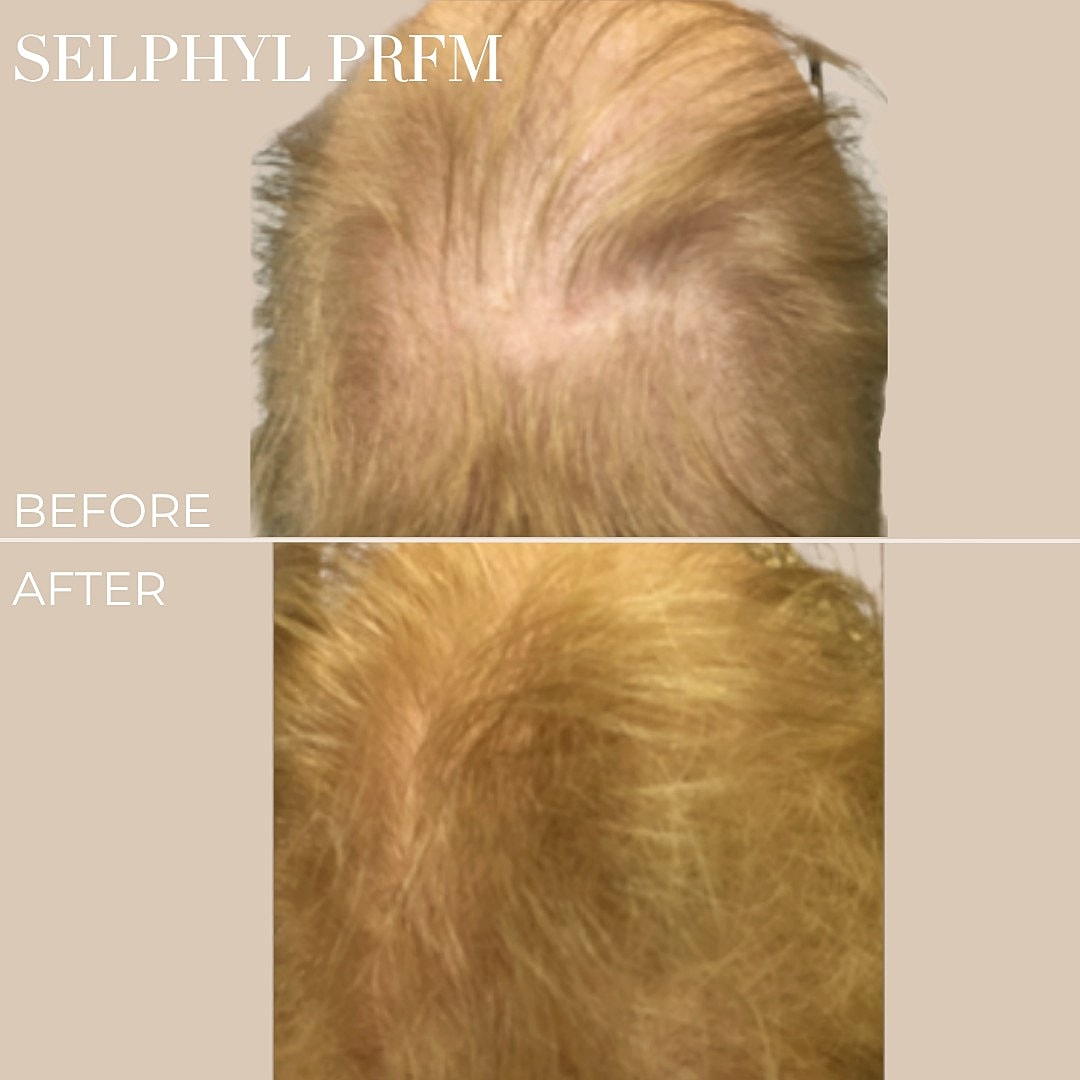 Hair restoration results before and after treatment