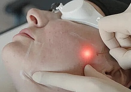 Facial treatment using laser technology on skin.