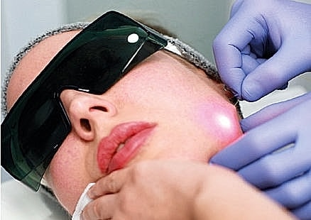 Laser treatment session on a woman's face.