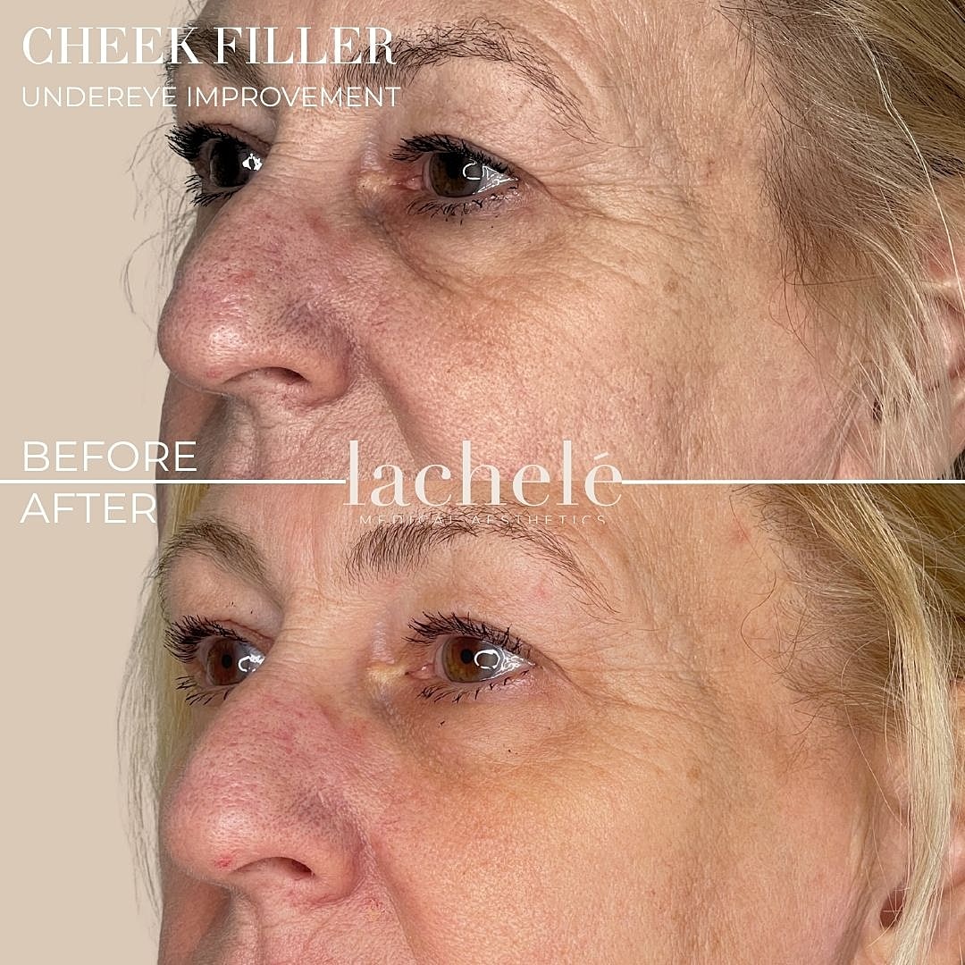 Cheek filler before and after under-eye improvement