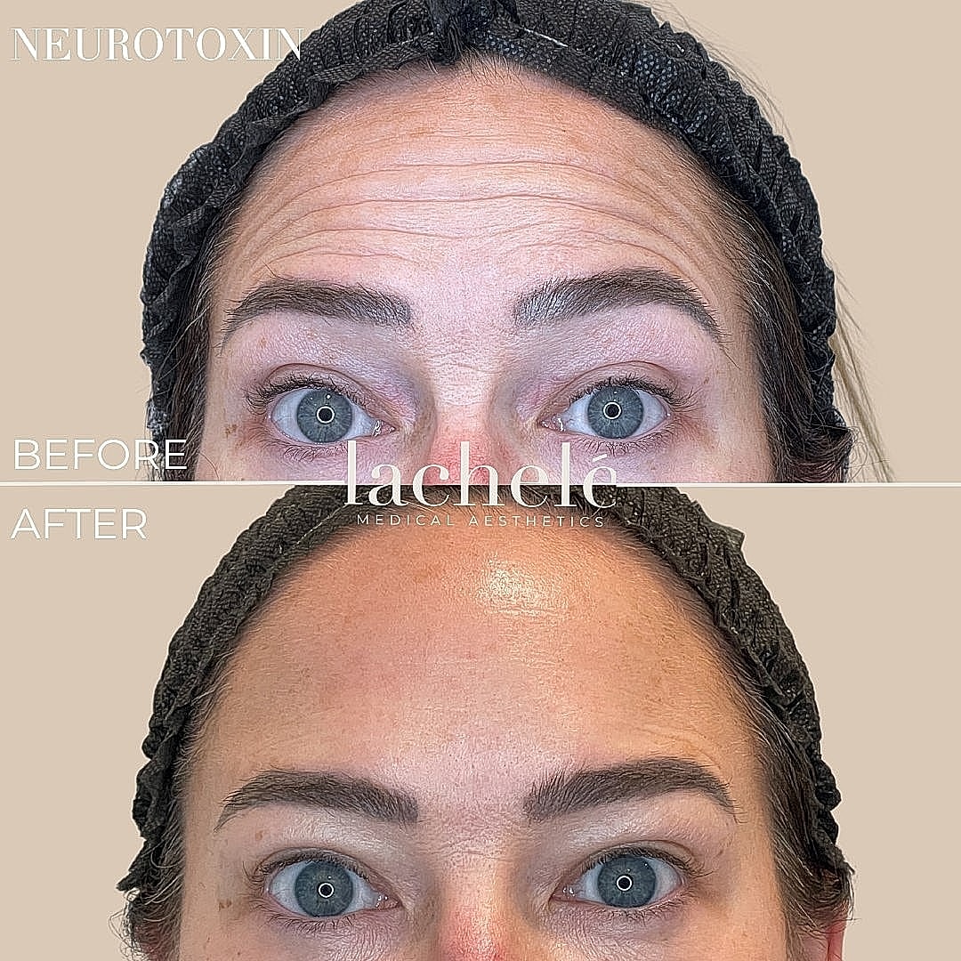 Neurotoxin treatment before and after results.