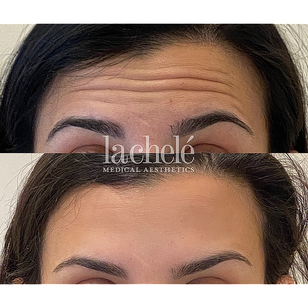 Before and after aesthetic treatment comparison.